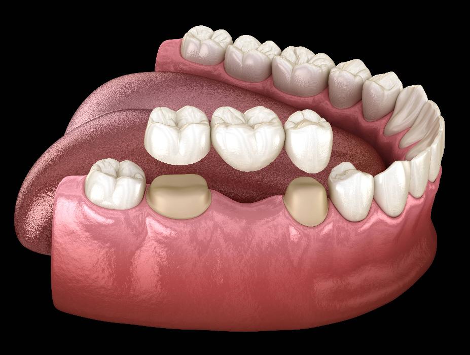 close up of dental bridge in mouth | dental implants teaneck nj