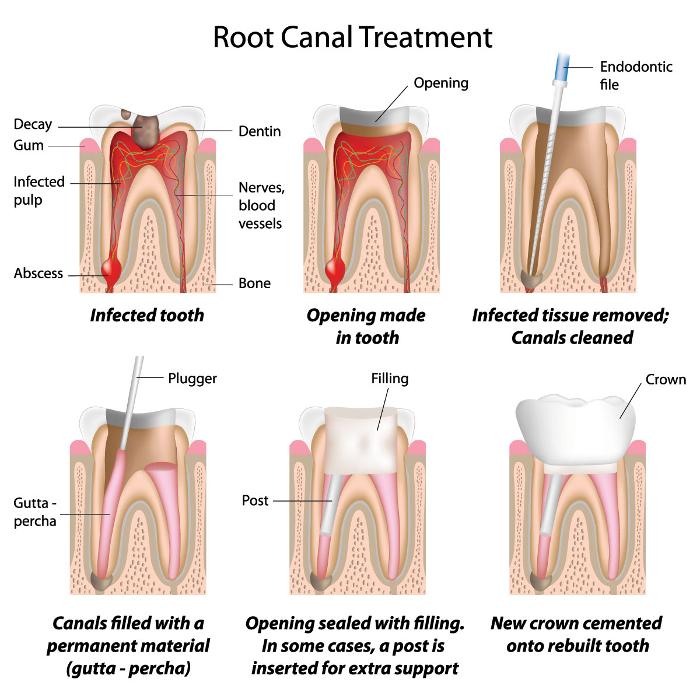 drawings of interior root canal procedure | root canal treatment teaneck