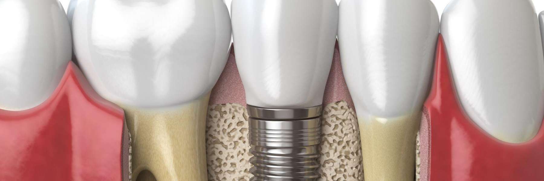 dental implant in jaw | dentist in teaneck nj
