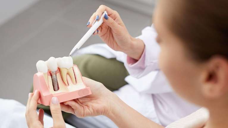 close up of dental implant model | dental implants teaneck nj
