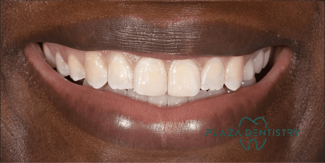 smile after dental treatment | dental bonding teaneck nj