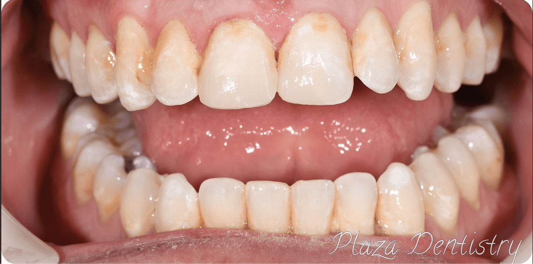 complete smile after dental bonding | teaneck dentist