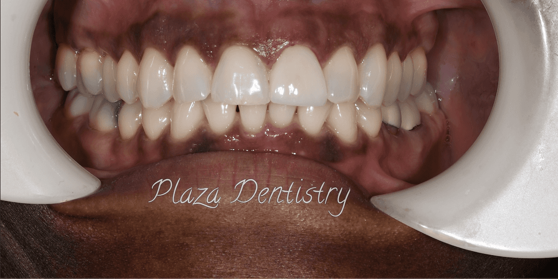 complete smile after treatment | dental crowns teaneck nj