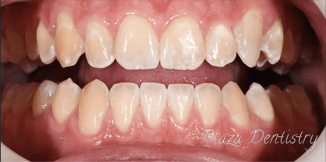 straight teeth after dental bonding | dentist in teaneck nj