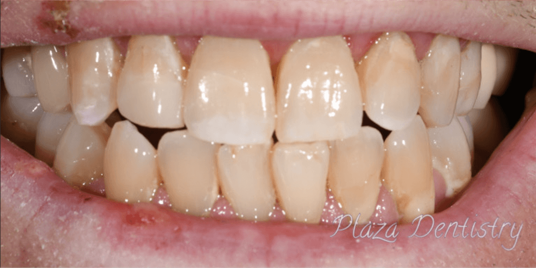 complete smile after dental bonding | emergency dentist teaneck nj