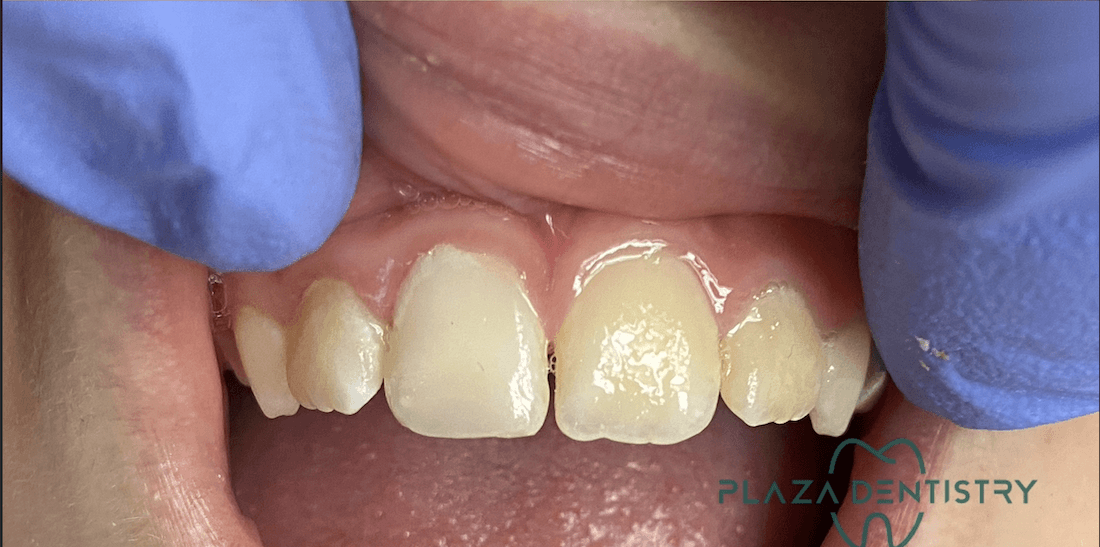 complete smile after treatment | cosmetic dentist teaneck nj