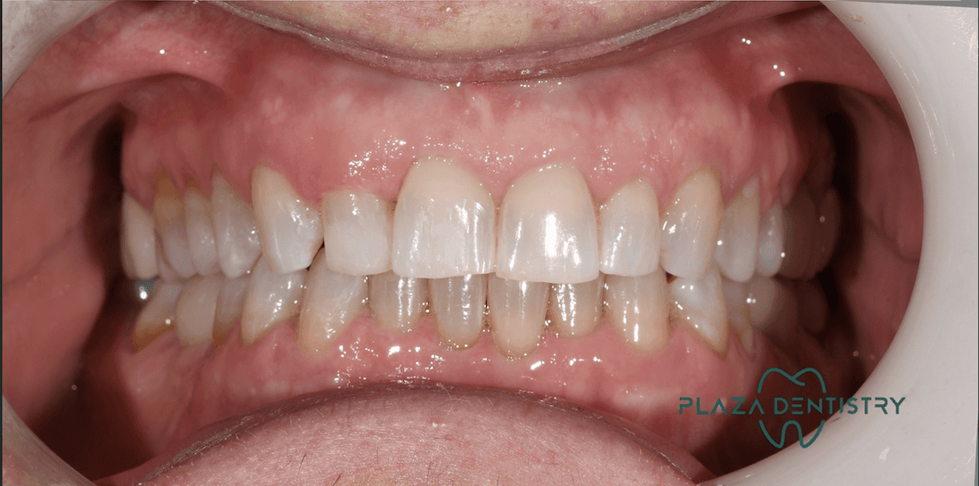 straight smile after dental treatment | invisalign teaneck nj