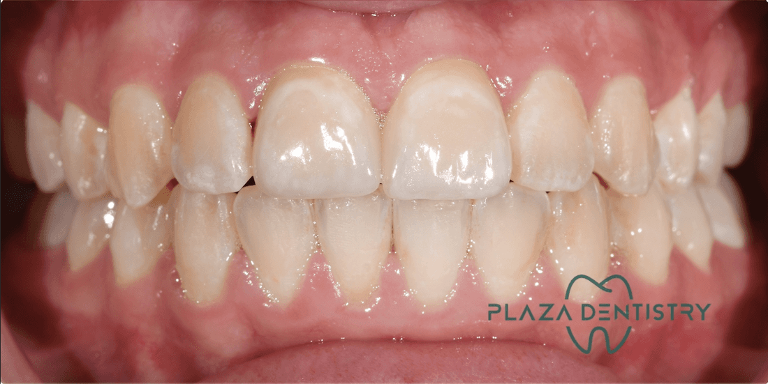 bright smile after treatment | teaneck dentist