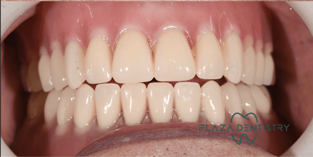 complete smile after treatment | dentist in teaneck nj