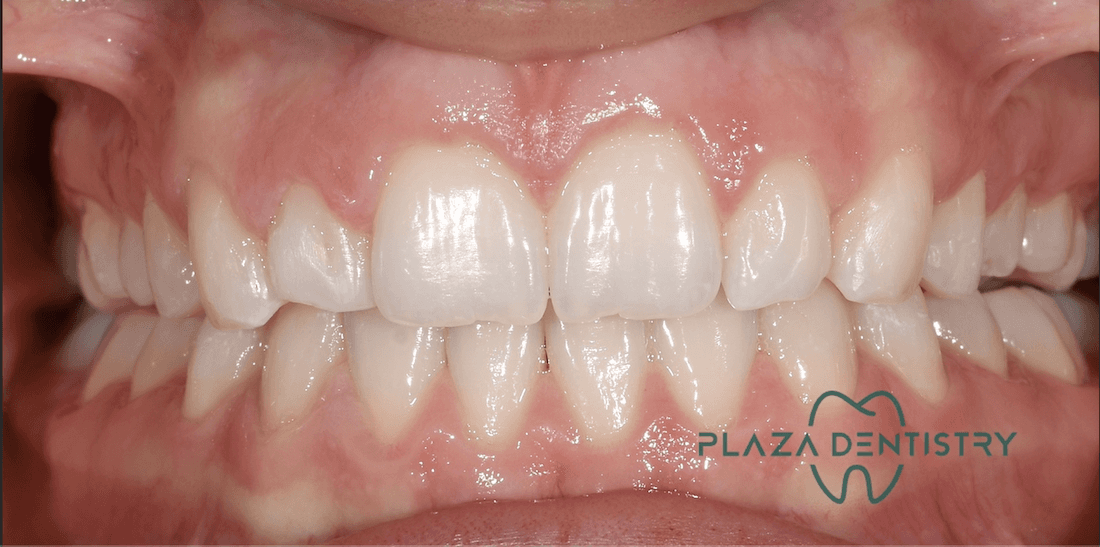 straight teeth after invisalign | teaneck dentist
