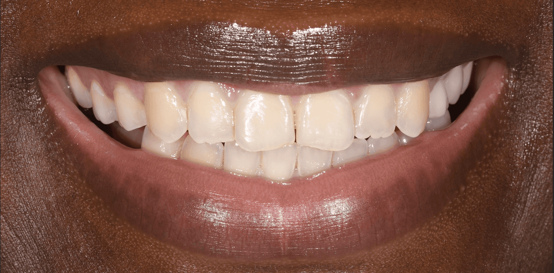 close up of smile before dental bonding | cosmetic dentistry teaneck nj