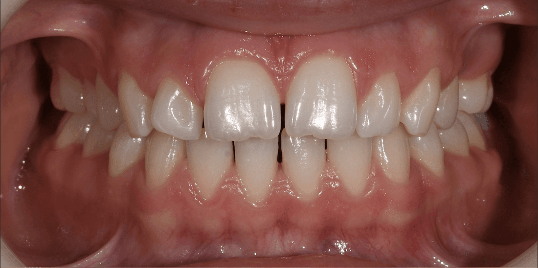 gap tooth before dental treatment | invisalign teaneck nj