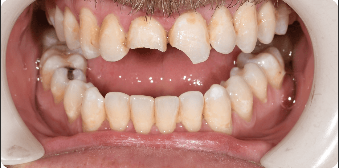 chipped teeth before treatment | dental bonding teaneck nj
