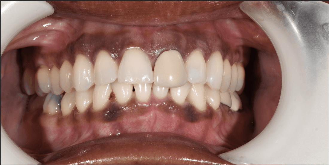 crooked smile before porcelain crowns | teaneck dentist
