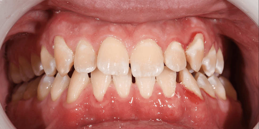 stained teeth before dental treatment | dental bonding teaneck nj