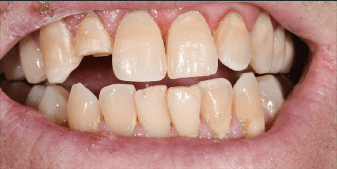broken tooth before dental treatment | dentist in teaneck nj