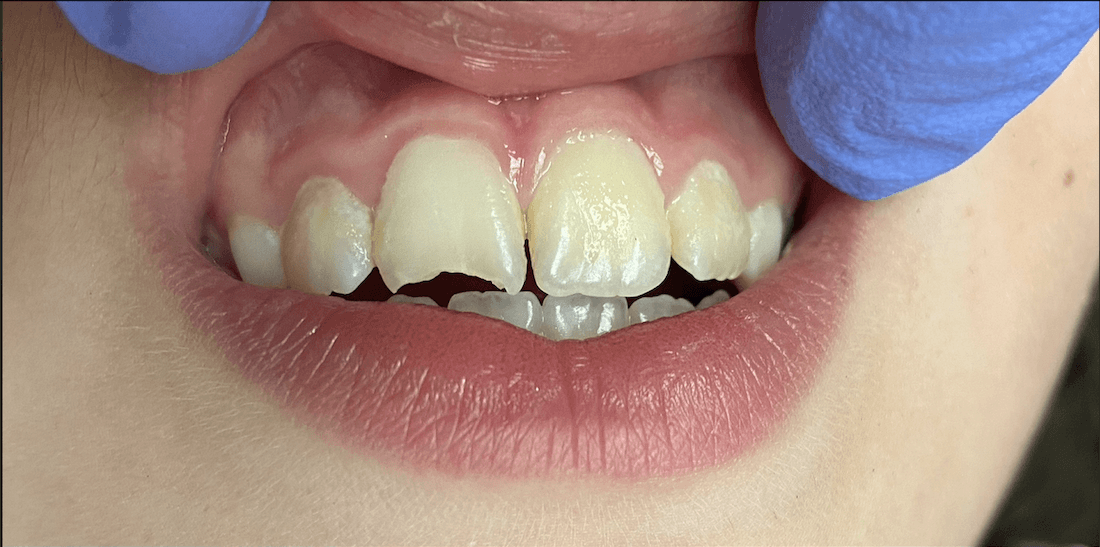 chipped tooth before dental bonding | dental bonding teaneck nj