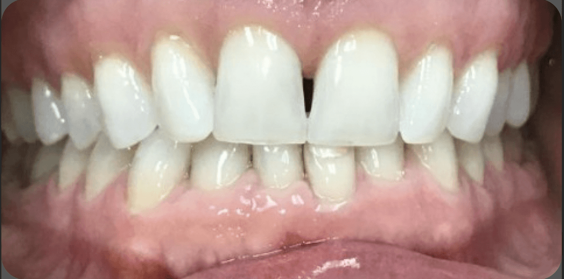 uneven lower teeth before treatment | dentist teaneck nj