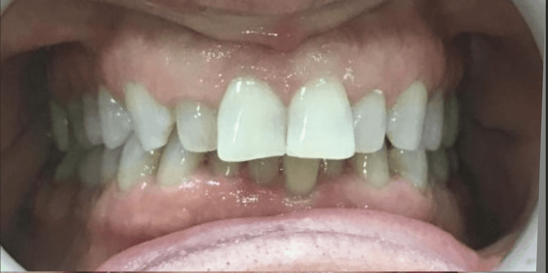 teeth before invisalign treatment | cosmetic dentistry teaneck nj