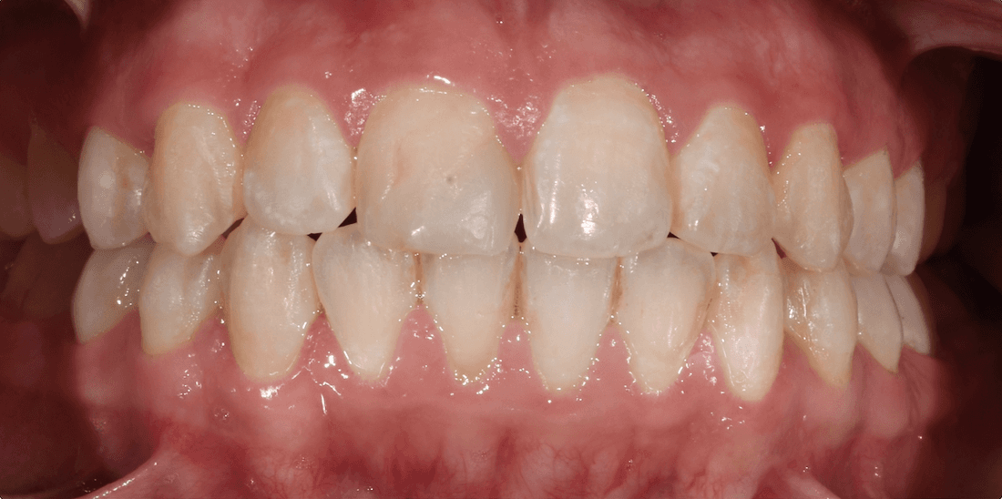 smile before dental treatment | porcelain veneers teaneck nj