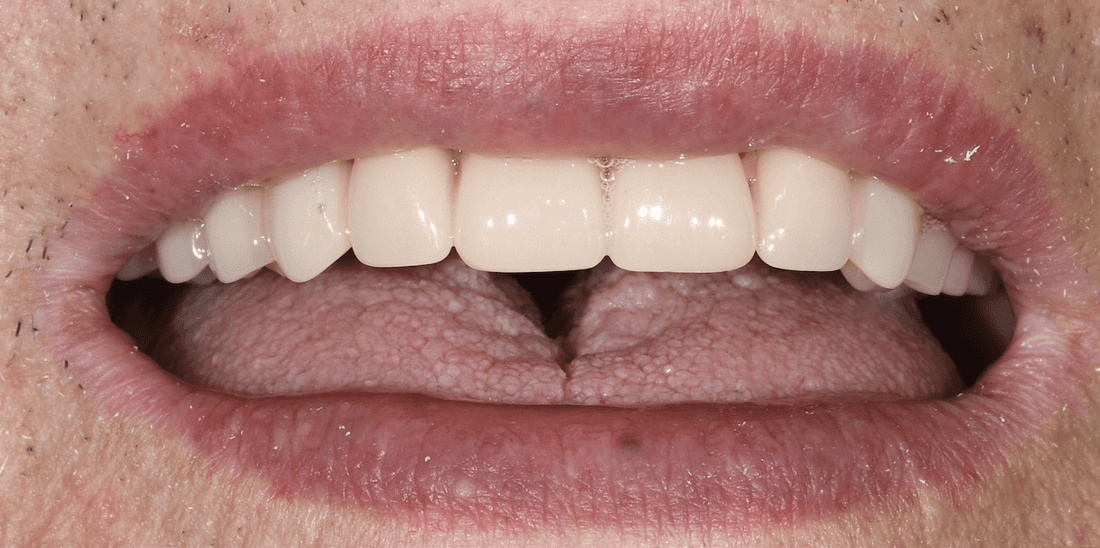 teeth before dentures | dentures teaneck nj