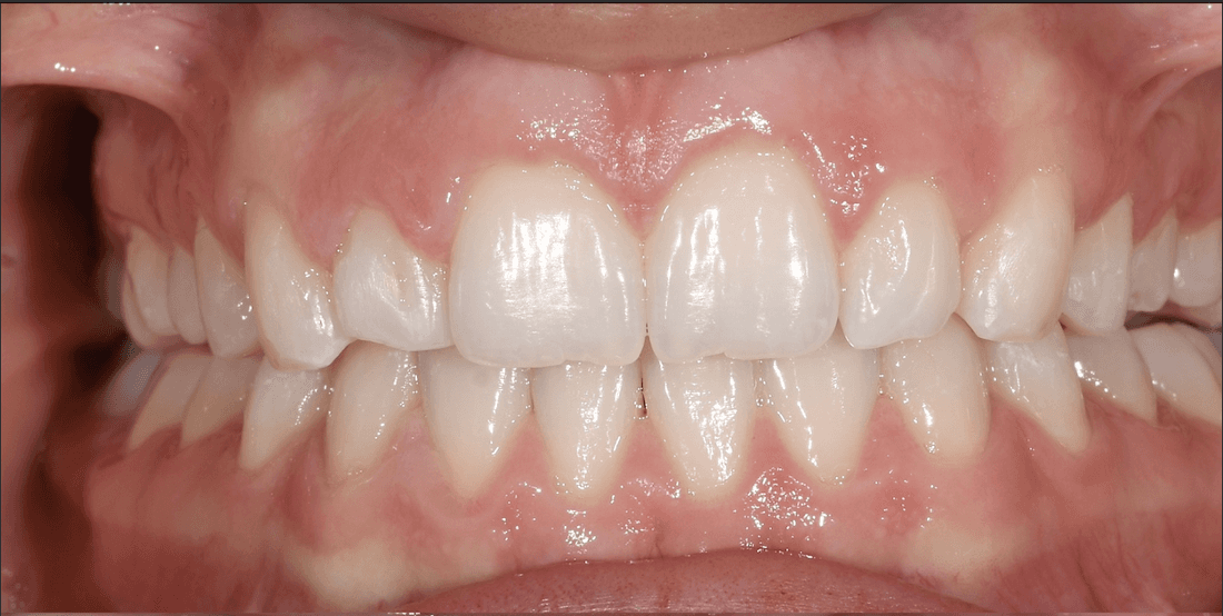 gummy smile before treatment | gum contouring teaneck nj