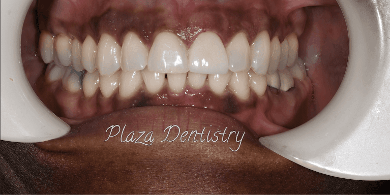 complete smile after treatment | dental crowns teaneck nj