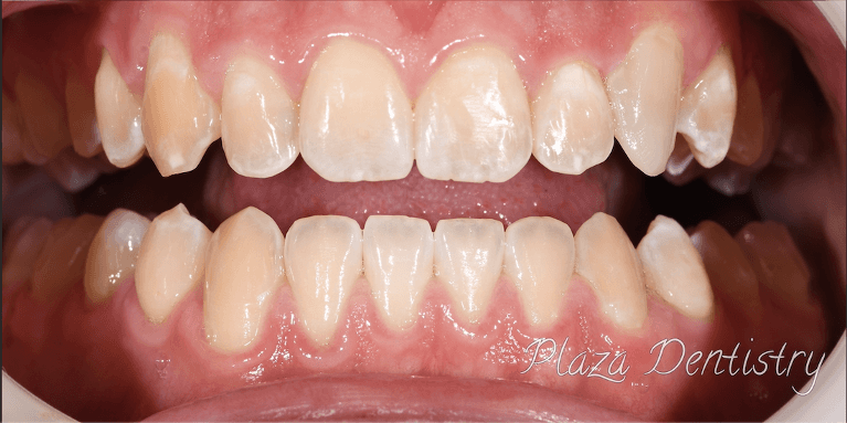 straight teeth after dental bonding | dentist in teaneck nj