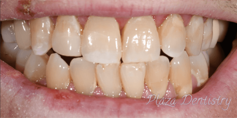 complete smile after dental bonding | emergency dentist teaneck nj