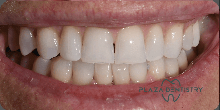 Invisalign-and-Porcelain-Veneers-After-Image