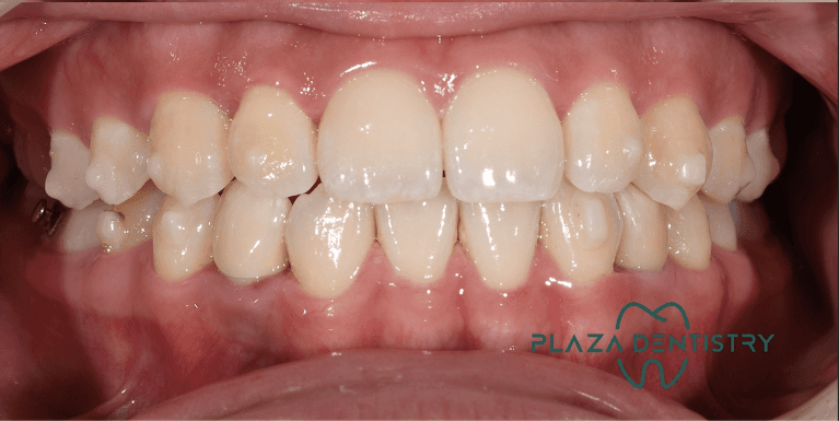 Renew-Your-Smile-With-Invisalign-Dental-Implants-After-Image