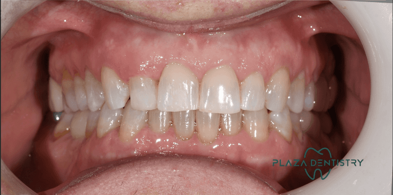 straight smile after dental treatment | invisalign teaneck nj