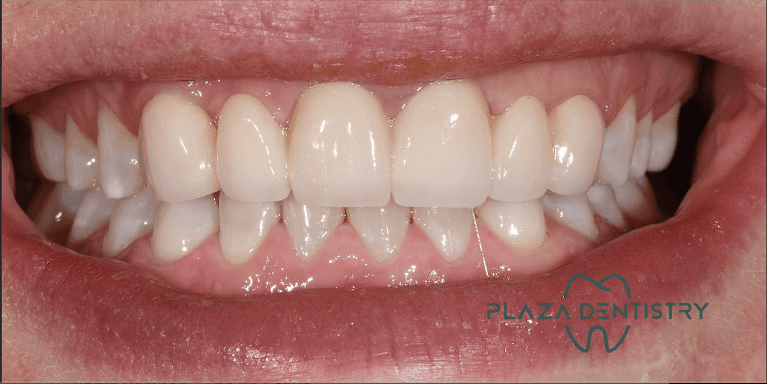 bright smile after restorative dentistry | teaneck dentist