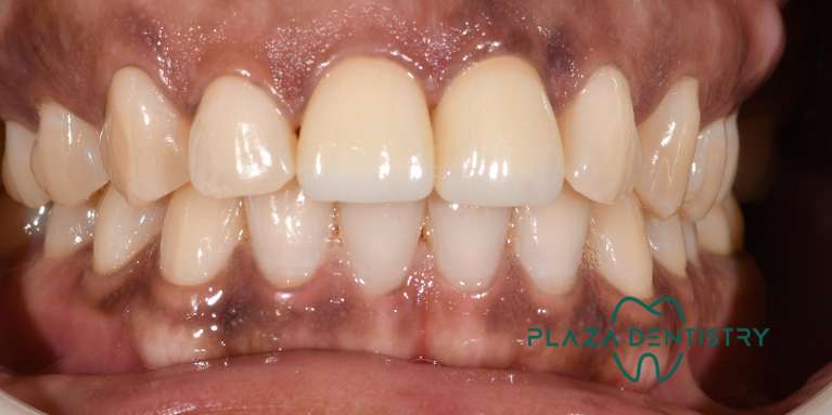 Cosmetic-crowns-After-Image