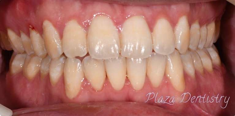 straight smile after treatment | cosmetic dentist teaneck nj