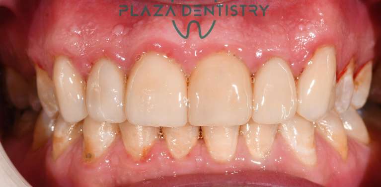 Porcelain-Veneers-After-Image