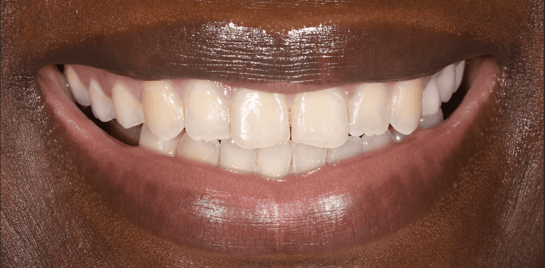 Dental-Bonding-Before-Image