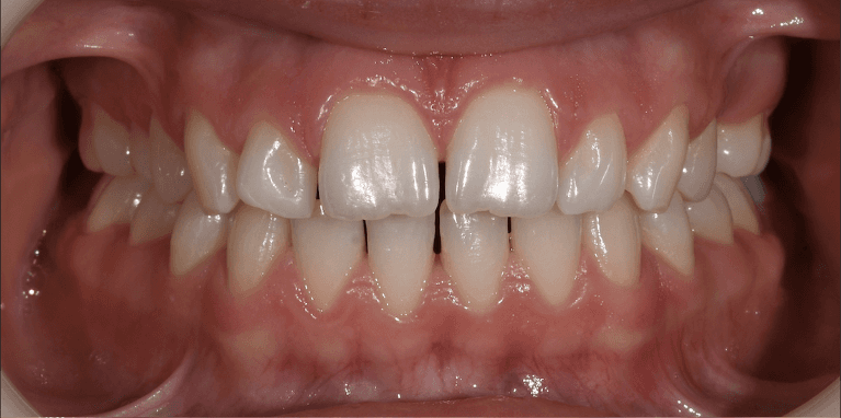 gap tooth before dental treatment | invisalign teaneck nj