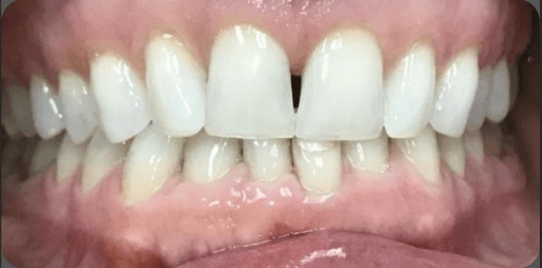 Invisalign-and-Porcelain-Veneers-Before-Image