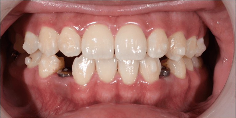 Renew-Your-Smile-With-Invisalign-Dental-Implants-Before-Image