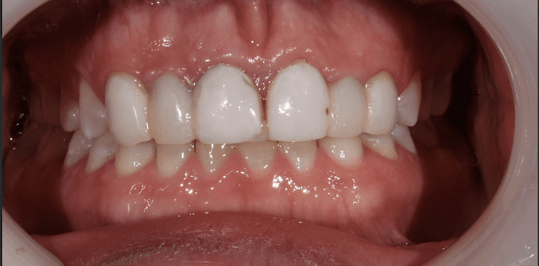 teeth before dental treatment | dental bridges teaneck nj