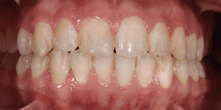 smile before dental treatment | porcelain veneers teaneck nj