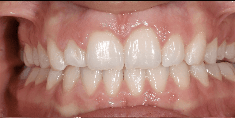 gummy smile before treatment | gum contouring teaneck nj