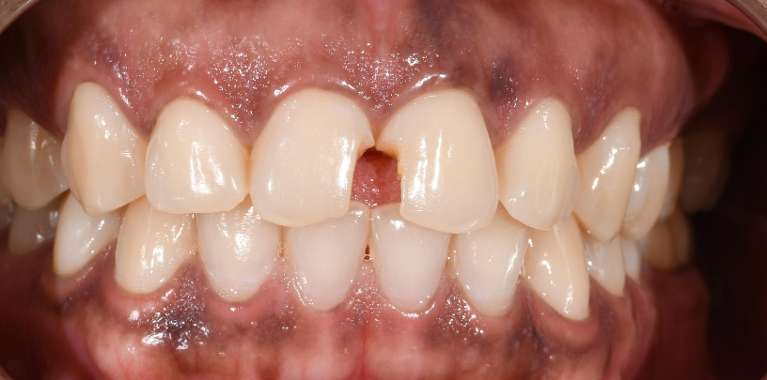 Cosmetic-crowns-Before-Image
