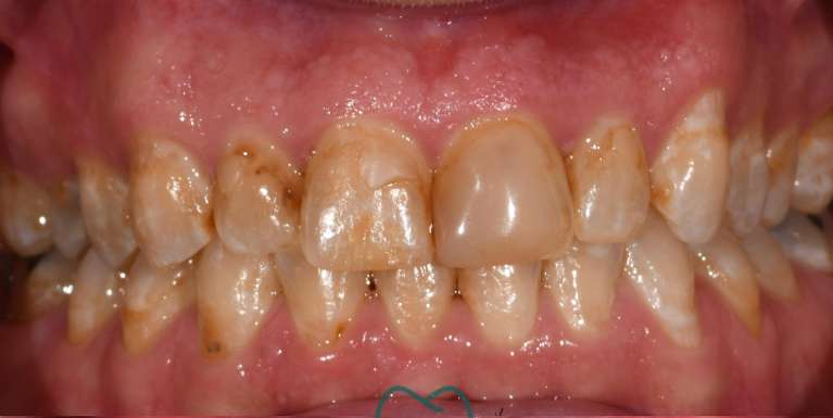 Porcelain-Veneers-Before-Image